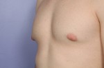 Breast Reduction (for Men) Before and after photo