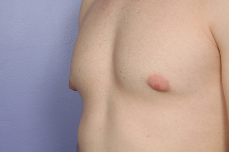 Breast Reduction (for Men) before and after photo