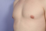 Breast Reduction (for Men) Before and after photo