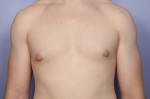 Breast Reduction (for Men) Before and after photo