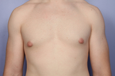 Breast Reduction (for Men) before and after photo