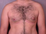 Breast Reduction (for Men) Before and after photo