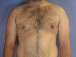 Breast Reduction (for Men) Before and after photo