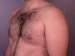 Breast Reduction (for Men)