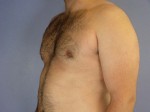 Breast Reduction (for Men) Before and after photo