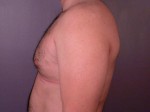 Breast Reduction (for Men) Before and after photo