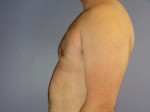 Breast Reduction (for Men) Before and after photo