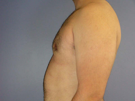 Breast Reduction (for Men) before and after photo