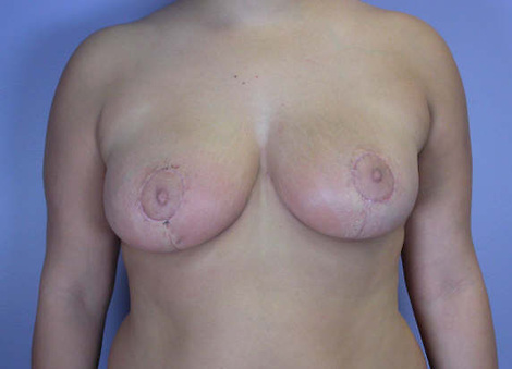 Breast Reduction (for Women) before and after photo