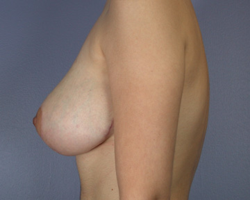 Breast Reduction (for Women) before and after photo