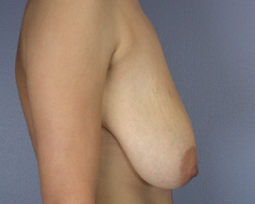 Breast Reduction (for Women) before and after photo