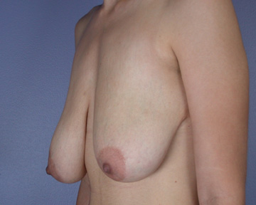 Breast Reduction (for Women) before and after photo