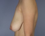 Breast Reduction (for Women) Before and after photo