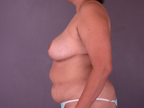 Breast Reduction (for Women) before and after photo