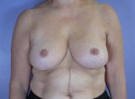 Breast Reduction (for Women)