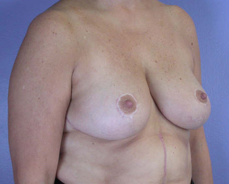 Breast Reduction (for Women) before and after photo