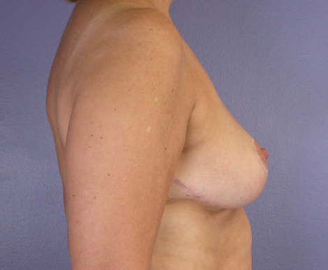 Breast Reduction (for Women) before and after photo