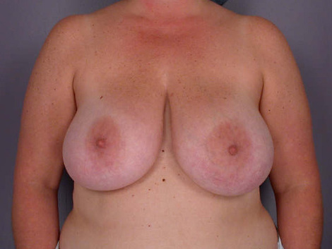 Breast Reduction (for Women) before and after photo