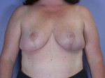 Breast Reduction (for Women)