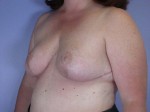 Breast Reduction (for Women)