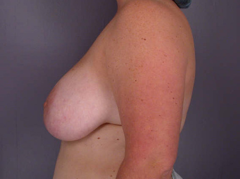 Breast Reduction (for Women) before and after photo