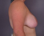 Breast Reduction (for Women) Before and after photo