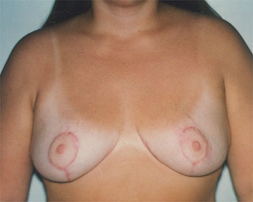 Breast Reduction (for Women) before and after photo