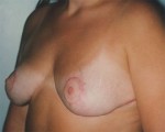 Breast Reduction (for Women)