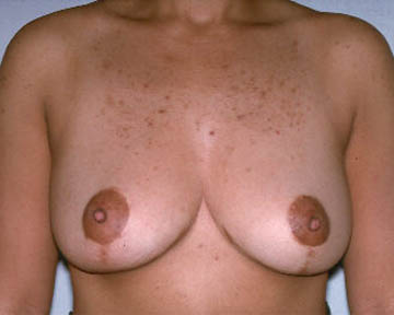 Breast Reduction (for Women) before and after photo