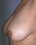 Breast Reduction (for Women) Before and after photo