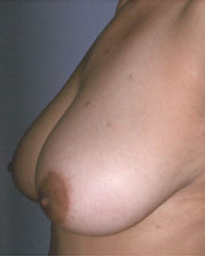 Breast Reduction (for Women) before and after photo