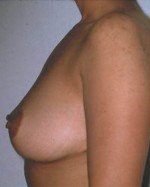 Breast Reduction (for Women)