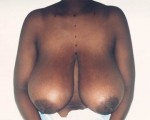 Breast Reduction (for Women)