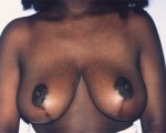 Breast Reduction (for Women) Before and after photo