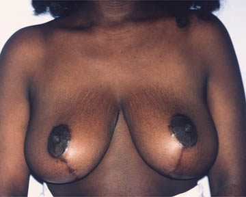 Breast Reduction (for Women) before and after photo