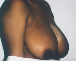 Breast Reduction (for Women) Before and after photo