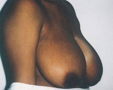 Breast Reduction (for Women) before and after photo