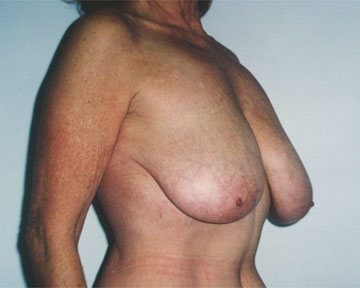 Breast Reduction (for Women) before and after photo