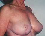 Breast Reduction (for Women) Before and after photo