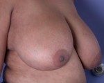 Breast Reduction (for Women) Before and after photo