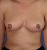 Breast Reduction (for Women) Before and after photo