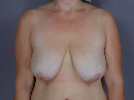 Breast Reduction (for Women) before and after photo