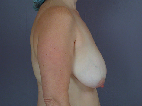 Breast Reduction (for Women) before and after photo