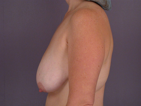 Breast Reduction (for Women) before and after photo