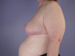 Breast Reduction (for Women) Before and after photo