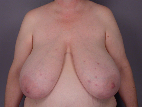 Breast Reduction (for Women) before and after photo