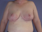 Breast Reduction (for Women) Before and after photo