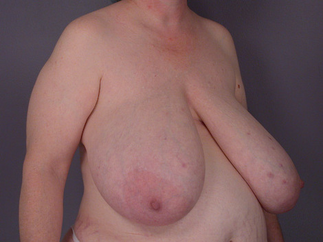 Breast Reduction (for Women) before and after photo