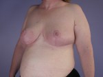 Breast Reduction (for Women) Before and after photo