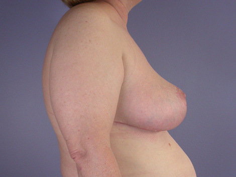 Breast Reduction (for Women) before and after photo